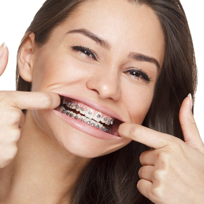 Women with braces